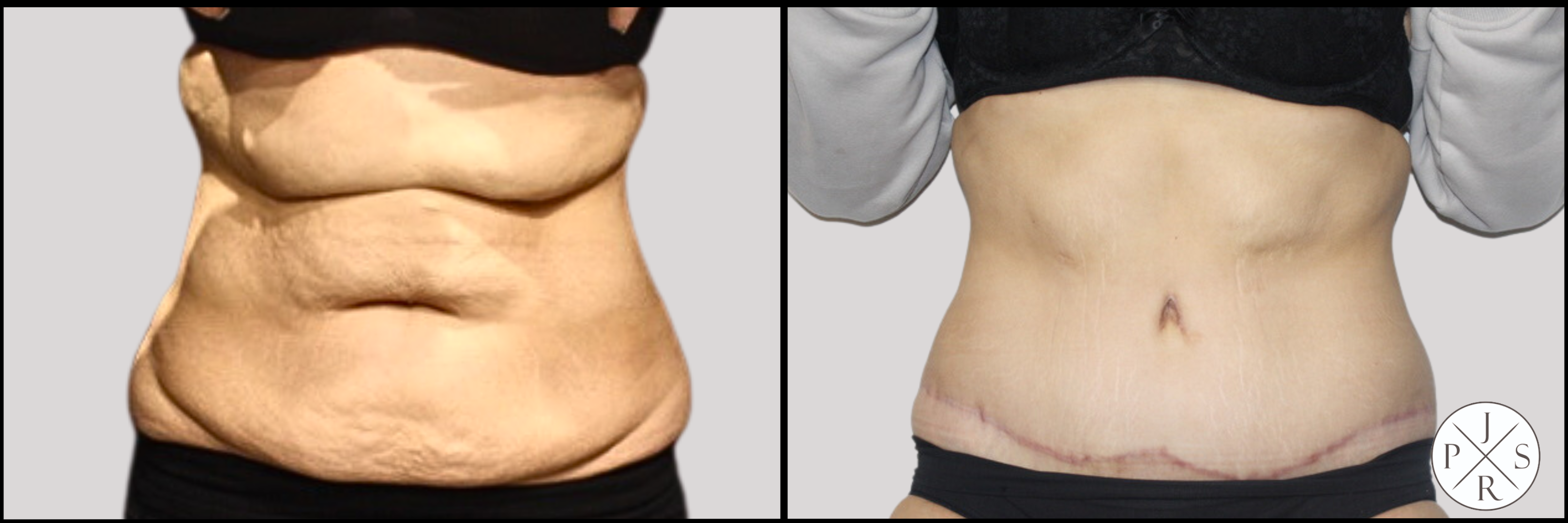 Abdominoplasty Before & After Image